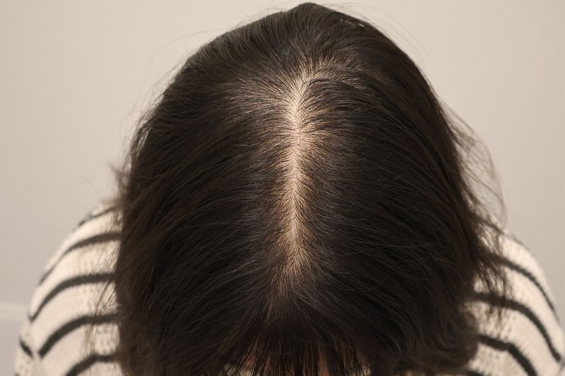 17th review of scalp treatment
