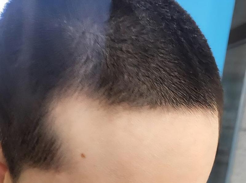 Hair loss born in 2006?