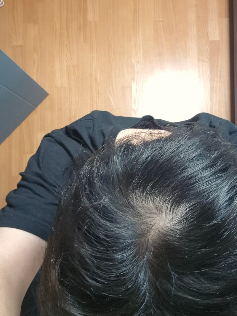22살 탈모일까요