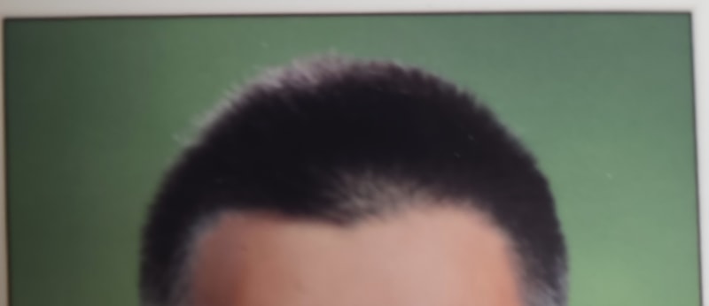 30살 탈모인가요??