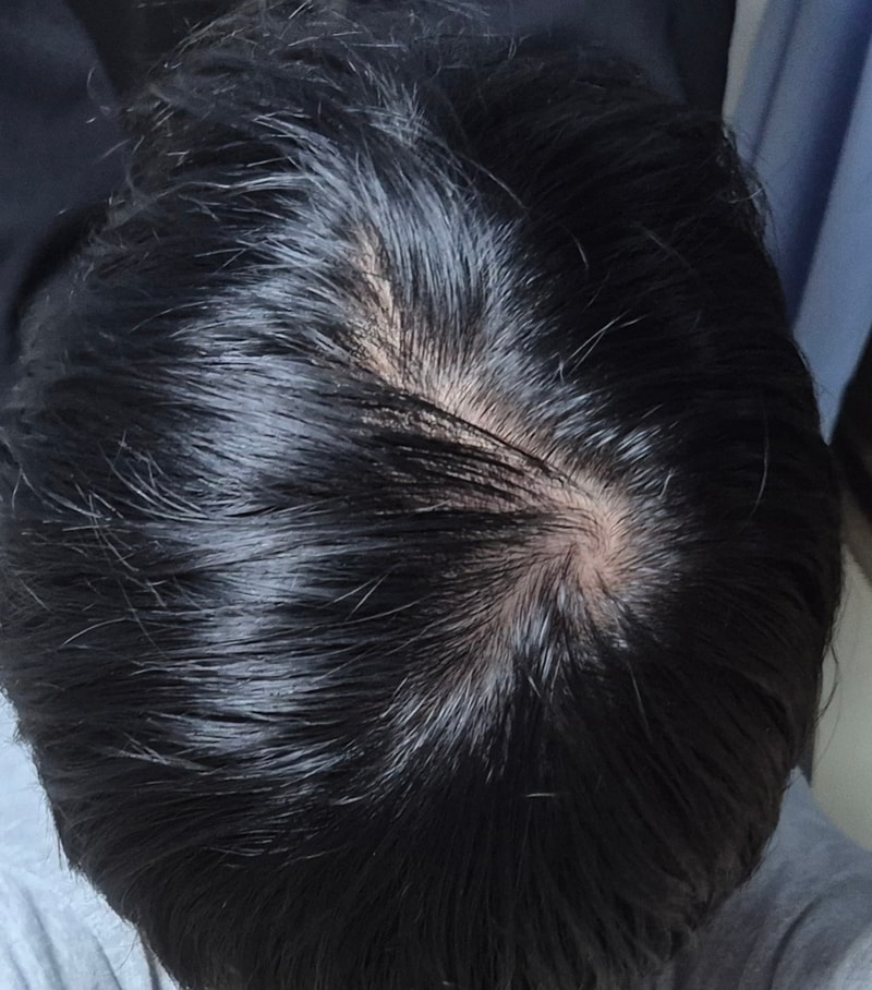 고등학생 탈모인가요 한번만 봐주세요..
