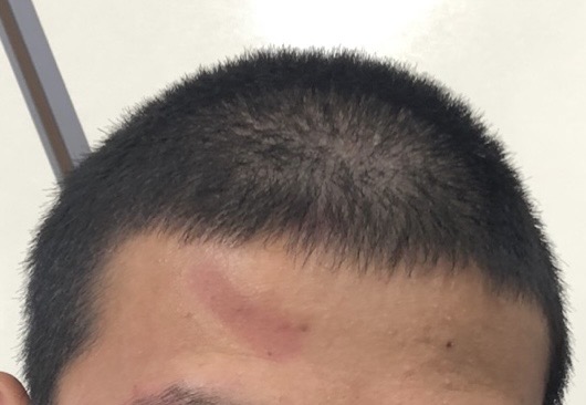 탈모인가요?+해결법