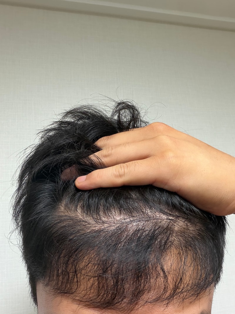 모발이식 8개월차 리터치 해야할까요?