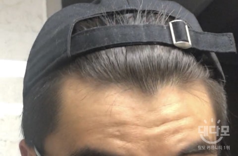 년도별 이마 사진인데 많이 진행됬나요?,,,