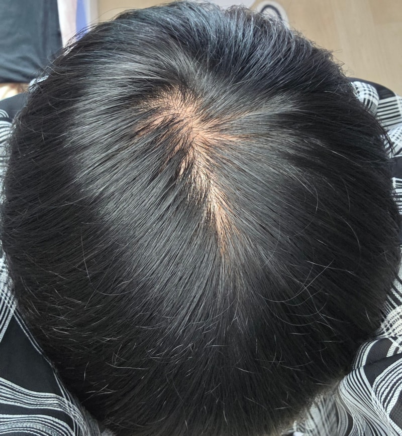 이정도면 정수리 탈모라고 봐야하나요?