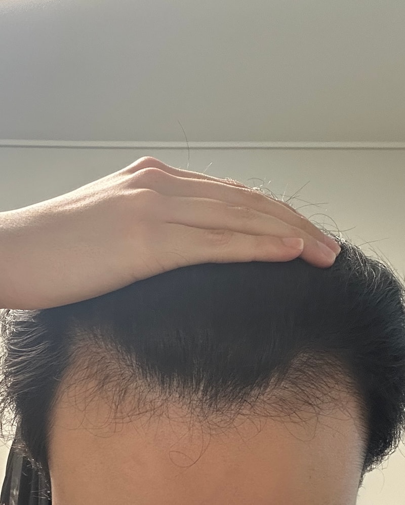 이소티논 m자 탈모