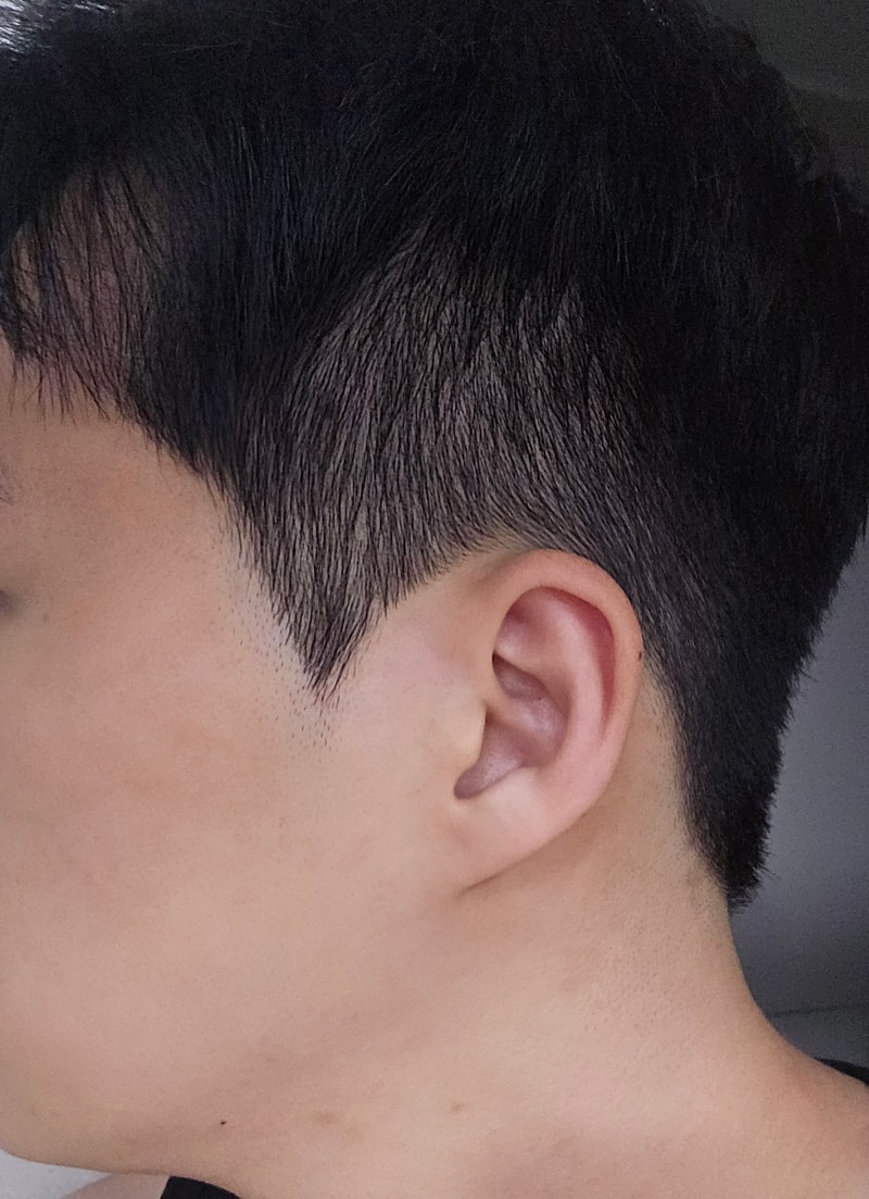 M자탈모 이식 2000모 정도 하는데 구렛나루도 할까요?