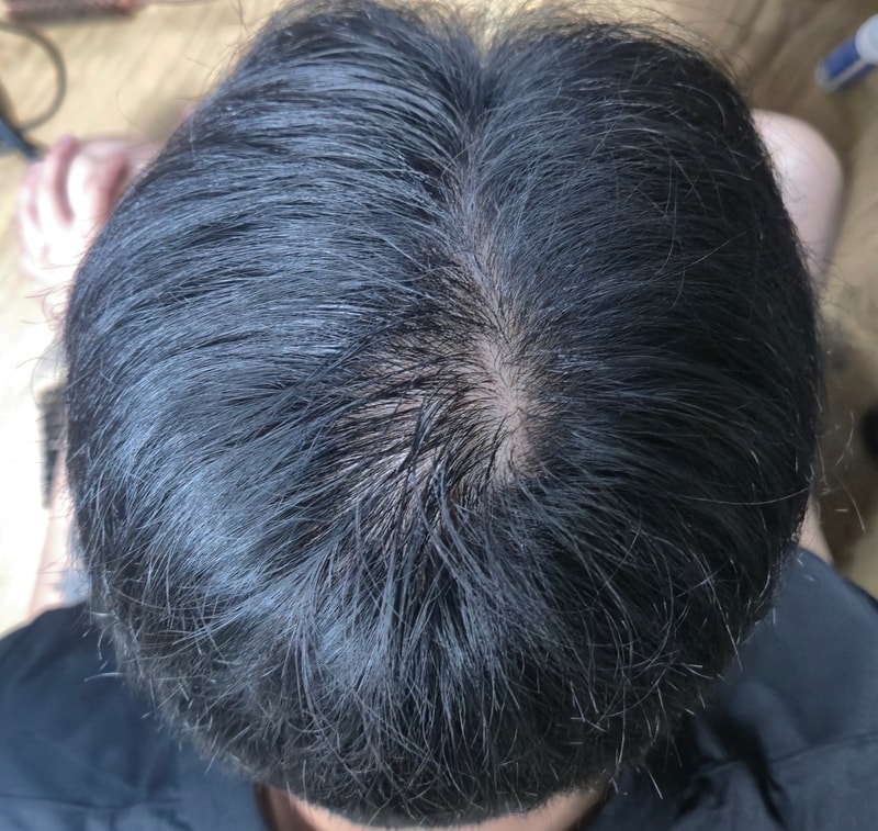 2년정도 피나스테리드 복용하다가 1년 미복용 하니 다시 정수리가 환해지기 시작합니다.