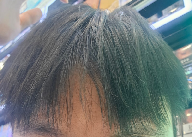 이거 탈모 늦은건가요?