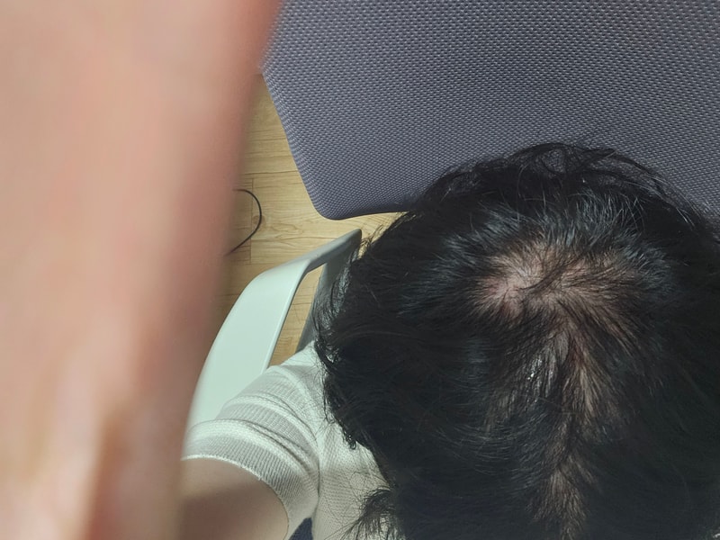 탈모가 맞겠죠..??