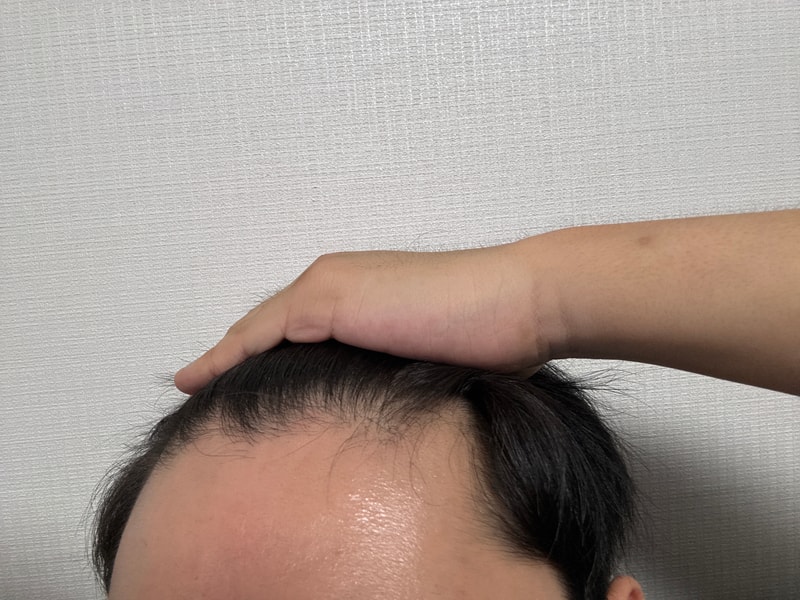 탈모인가요?