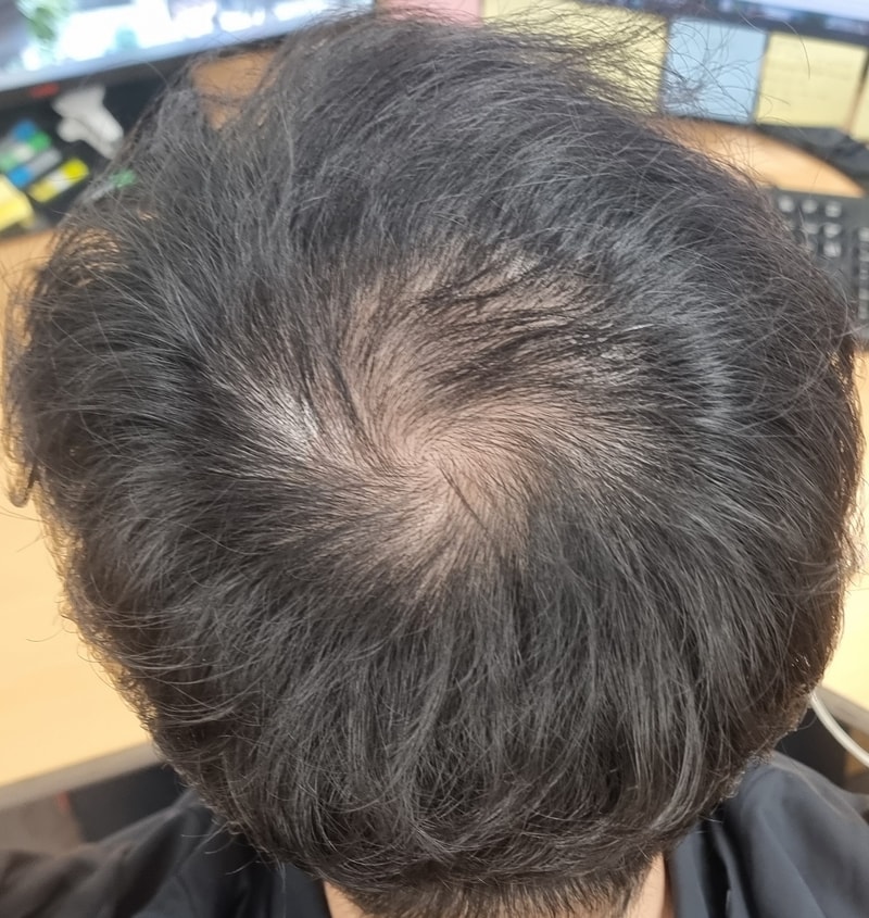 정수리 심각한가요? 