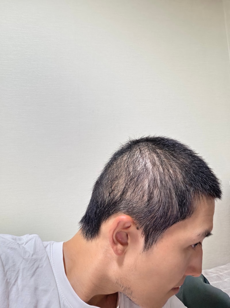 탈모 땜에 너무 힘들고 죽고싶네요 ..