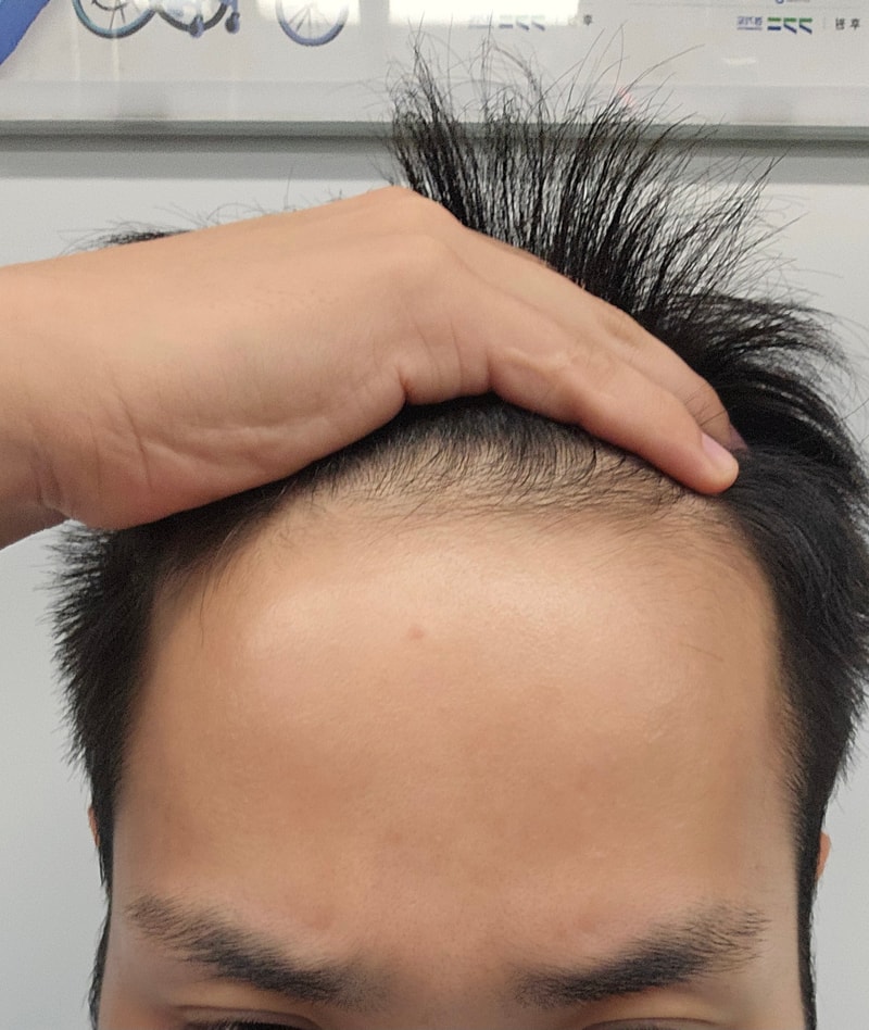 탈모 스트레스를 5년만에 해결해보려고 합니다..