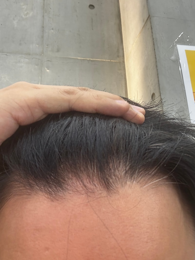 걱정되요..원형탈모인지 아니면 나이때문인지