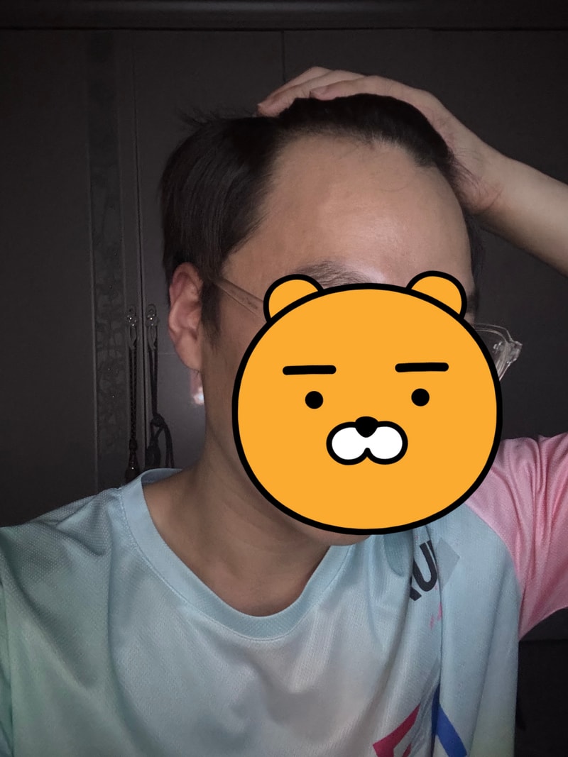 29살 남자 탈모인거겠죠..?