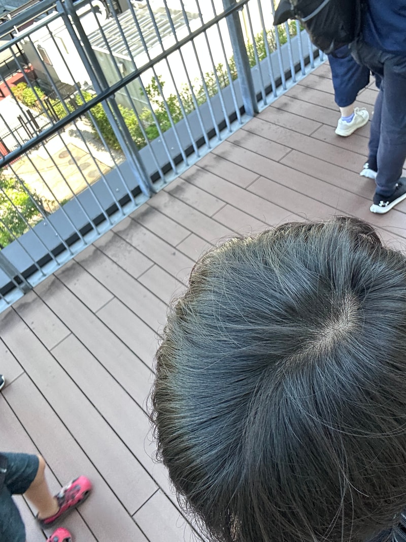 20세 탈모인가요