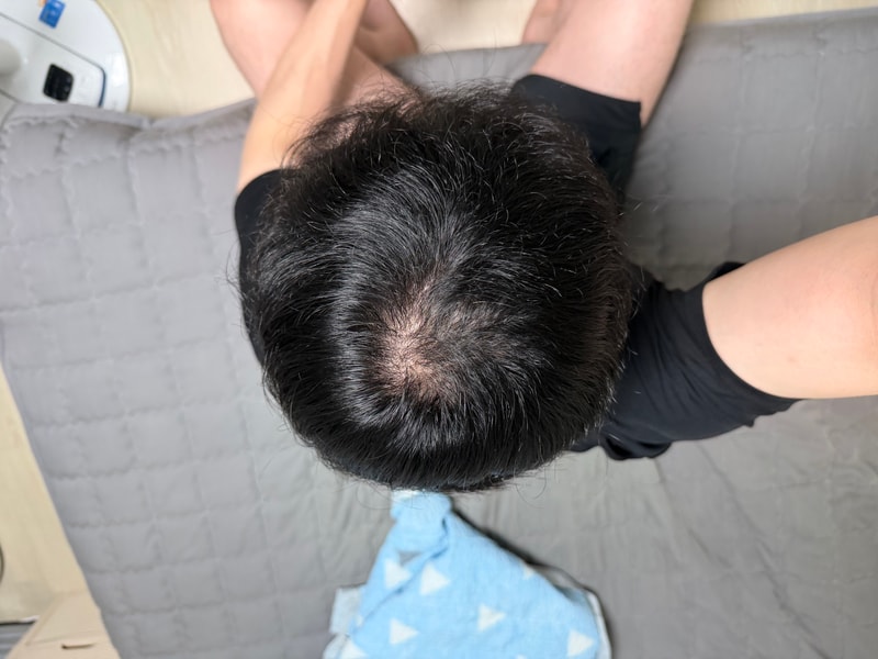 탈모인지 한 번만 봐주세요ㅜ