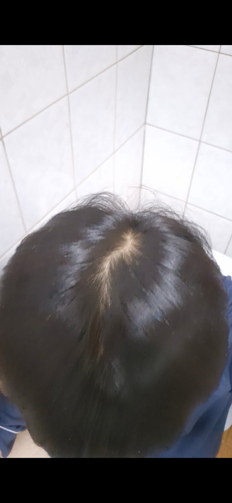 탈모인가요?