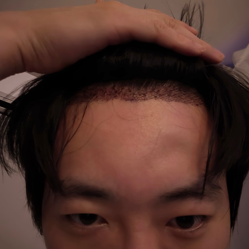 절개수술 2일차, 두피가 딱딱하고 잇몸 마취할 때처럼 감각이 더딘데 원래 이런가요?