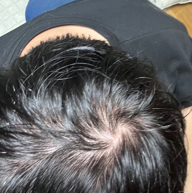 전두부 탈모가 있으면 피나에서 두타로 바꾸는게 맞나요?