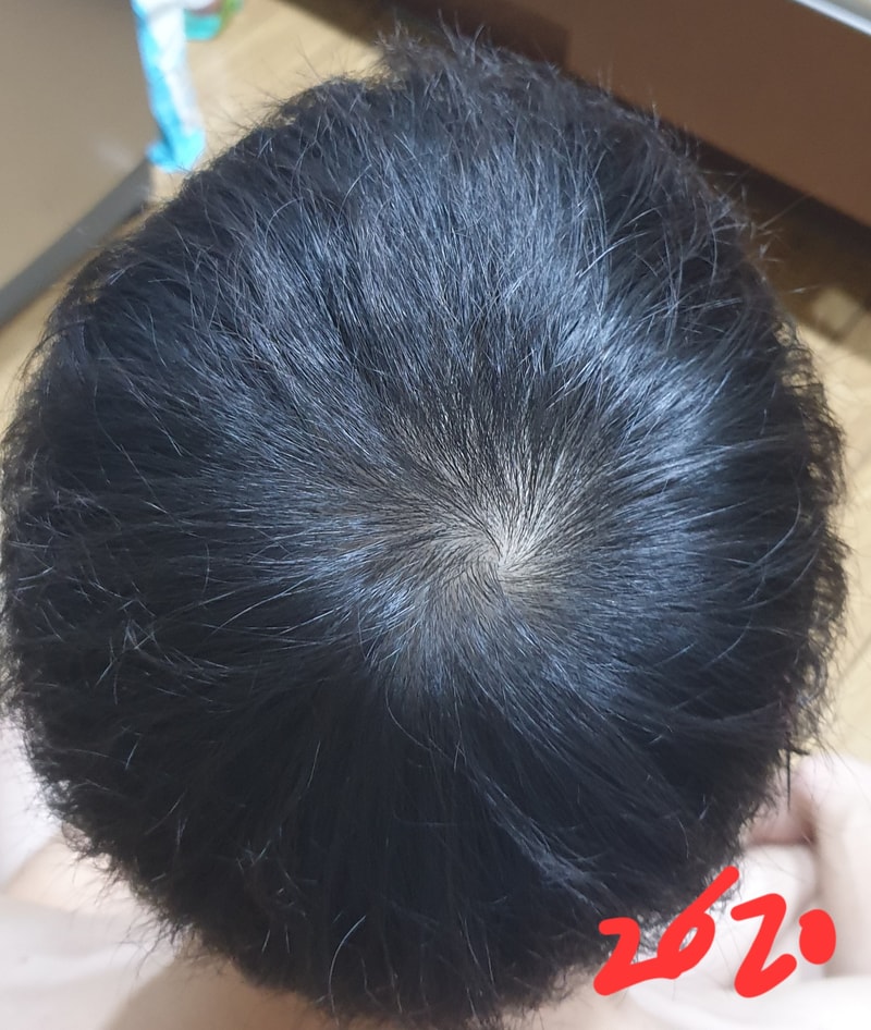 30살 남성 정수리 탈모 인가요?(년도별 사진 첨부)