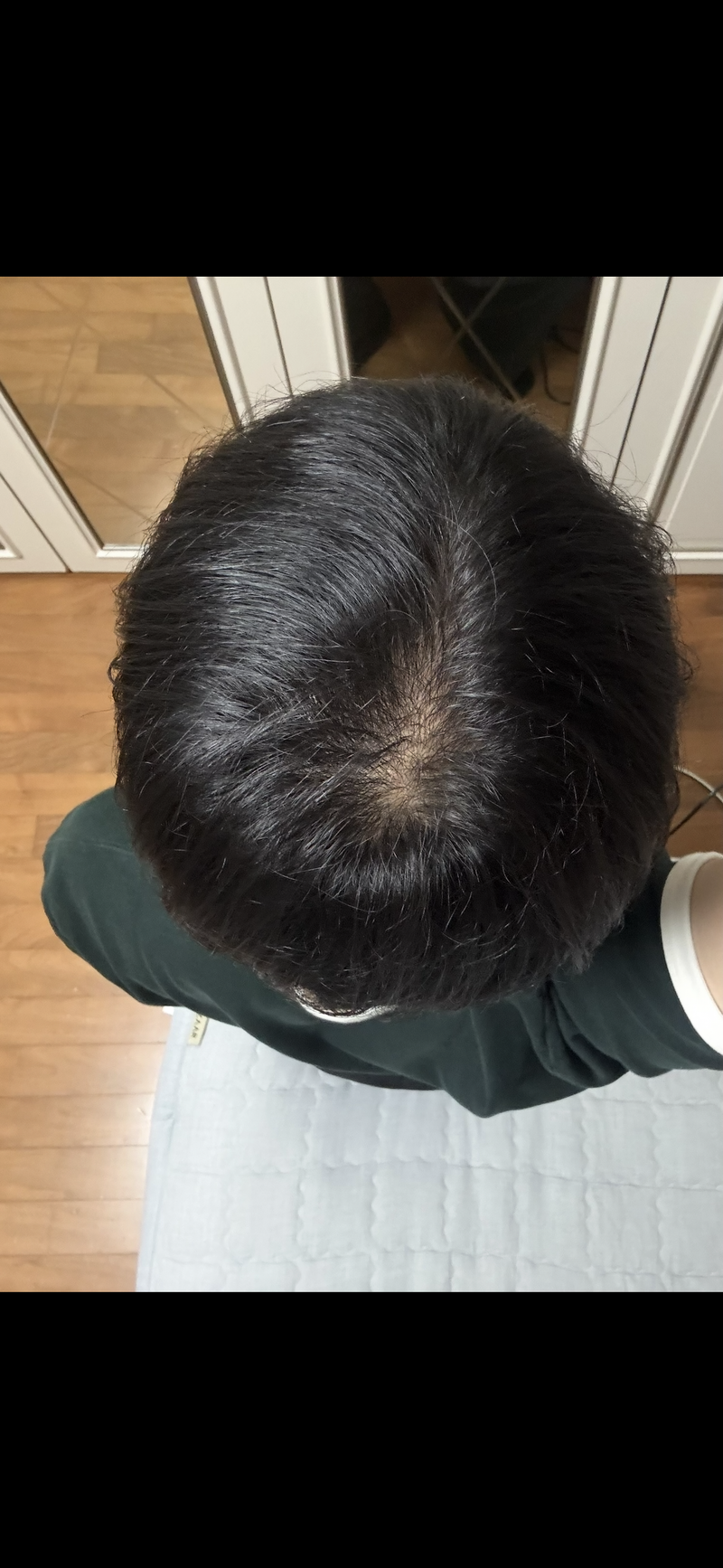 탈모약 1년 복용 악화되는 것 같아요,,,