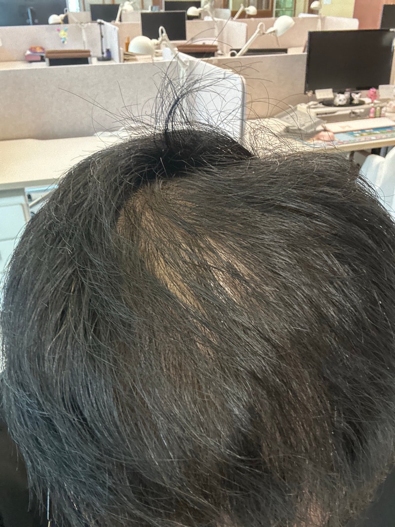 갑작스럽게 머리털이 엄청나게 빠지네요ㅠㅠ
