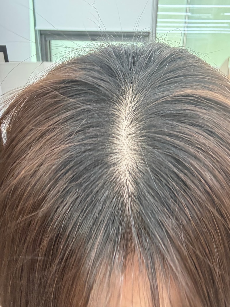 정수리 이정도면 탈모인가요?ㅠ