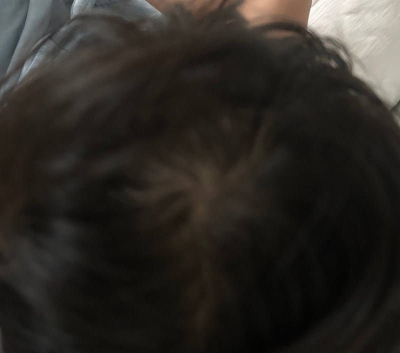 이거 탈모 초기예요?