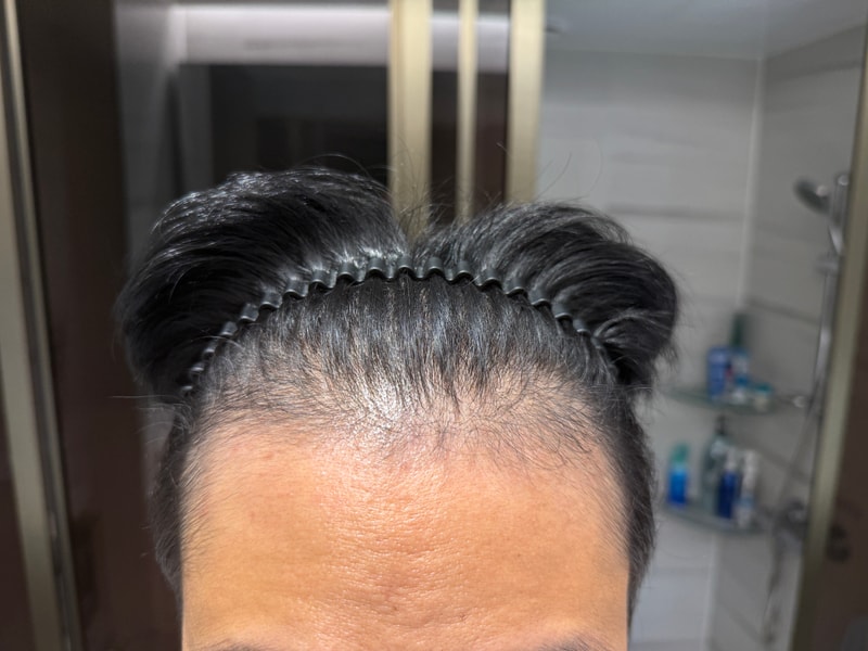 앞머리 탈모 질문