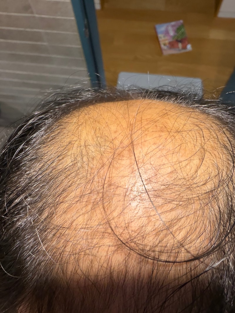 뉴헤어 모발 이식 후기