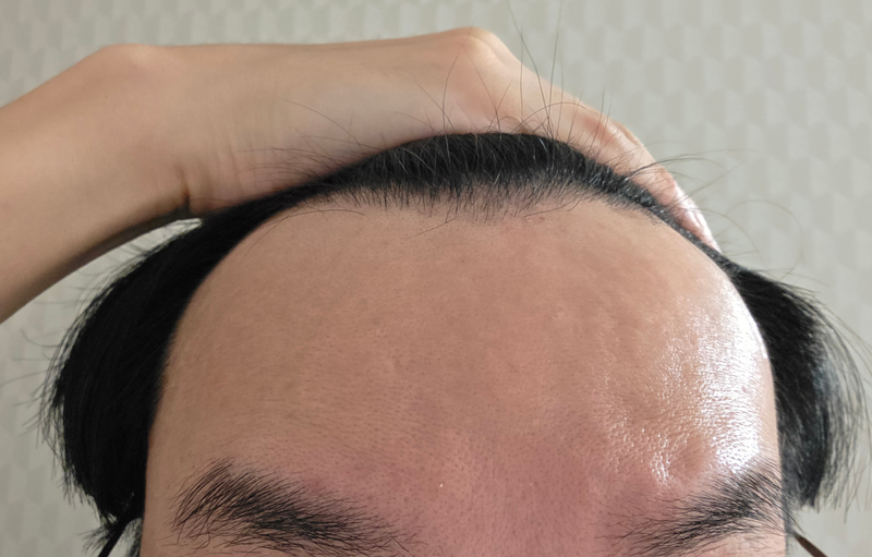 헤어로에서 수술하기 전 사진 보니까 감회가 새롭네요.