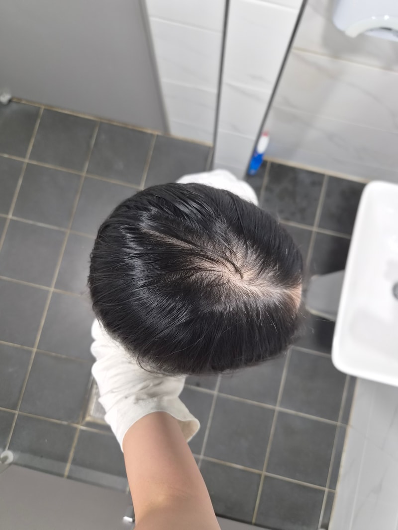여성탈모 고민