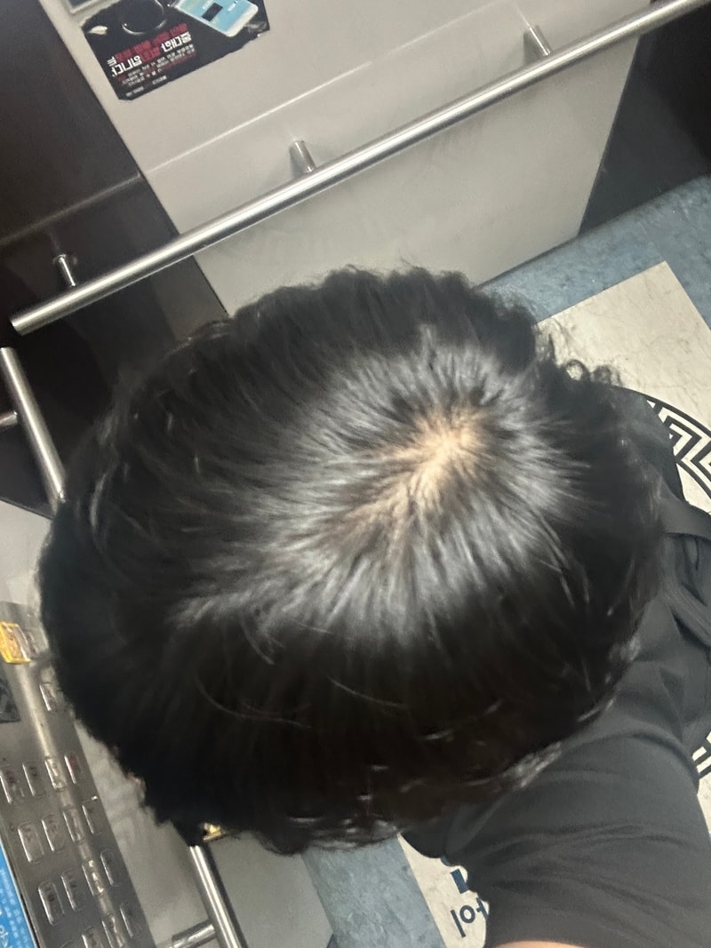 저 탈모인가요?? 