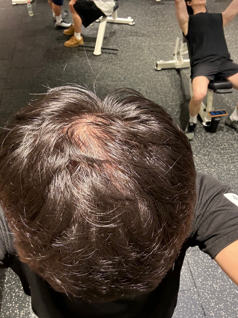 탈모고민 25