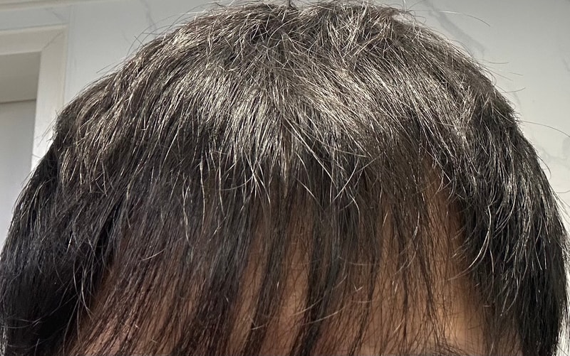 M자 앞머리 갈라짐 탈몬가요?
