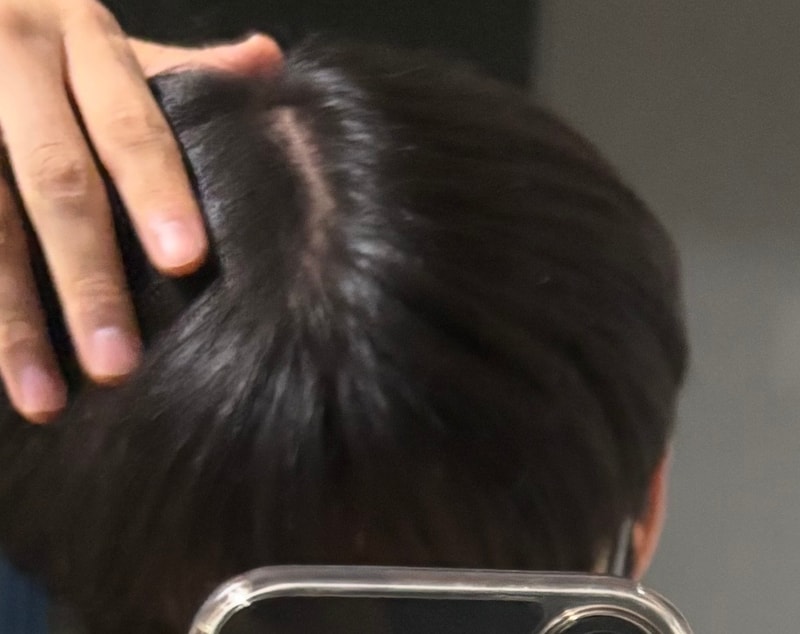 탈모인가요?