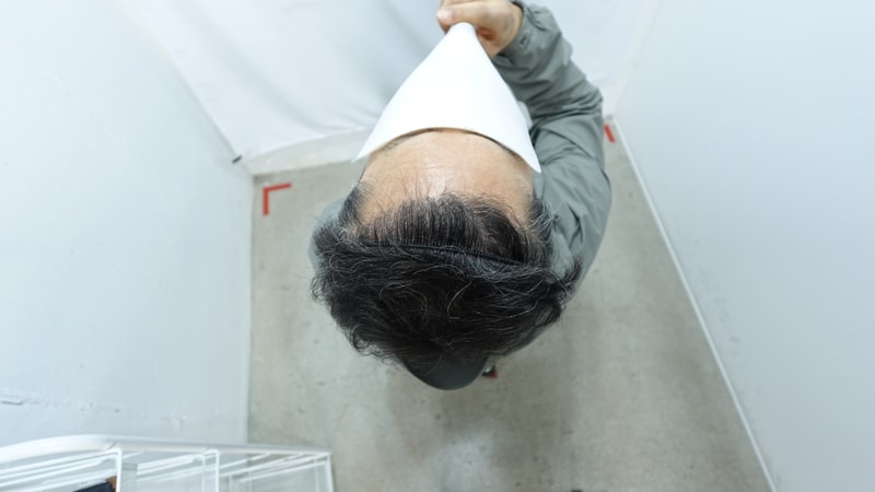자라다의원(6개월차 비절개 3,500모낭)