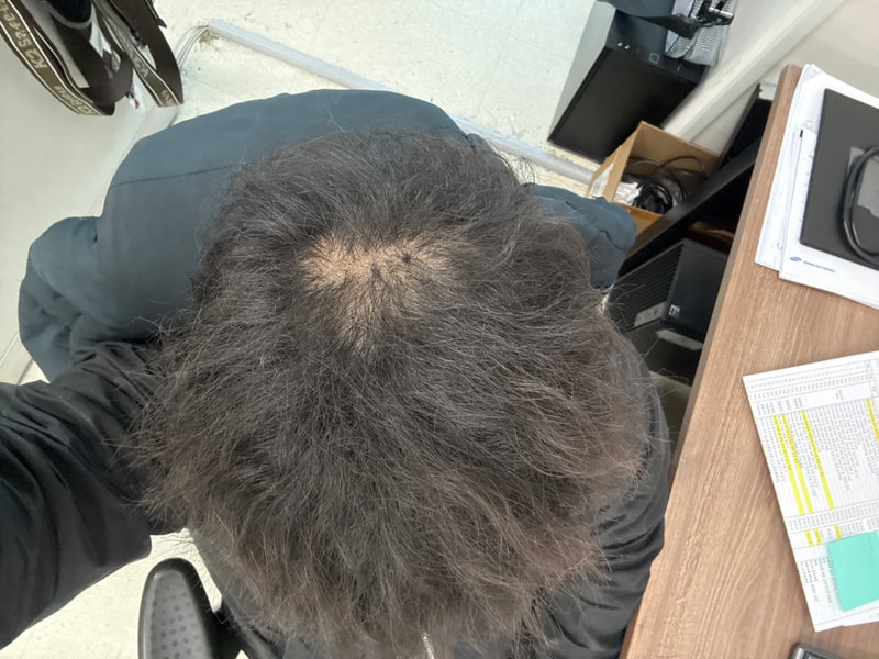 정수리 두피치료 4회차인데 보통 언제부터 득모 체감되셨나요?