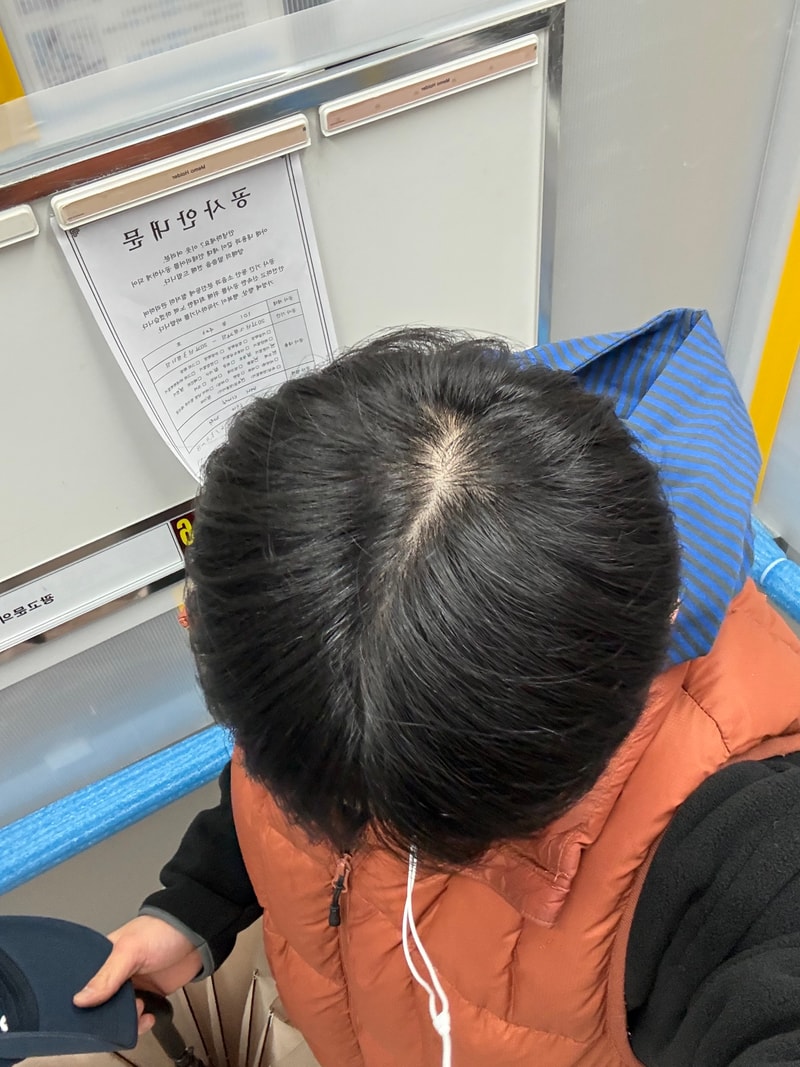 탈모 치료