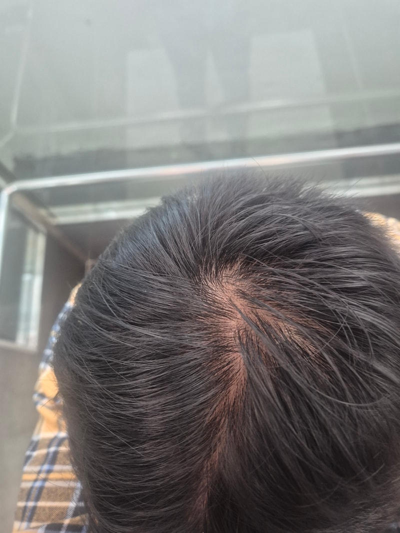 탈모인가요?