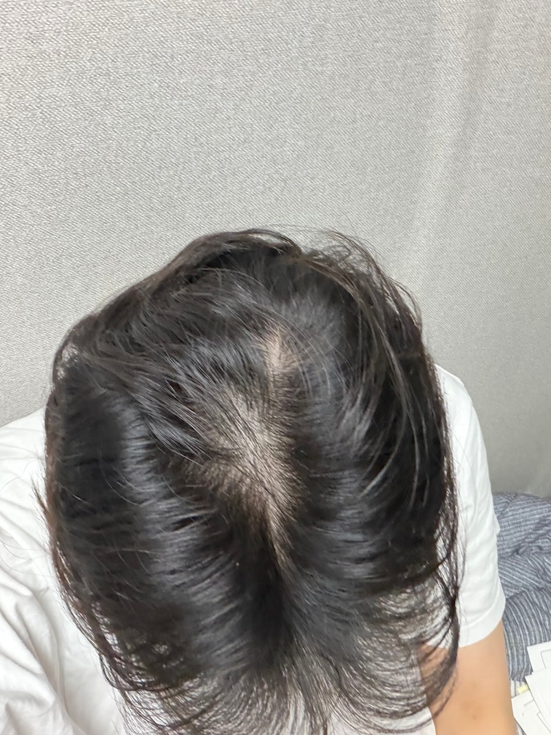 탈모인가요??ㅠㅠ