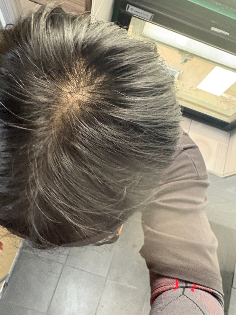 탈모인가요?