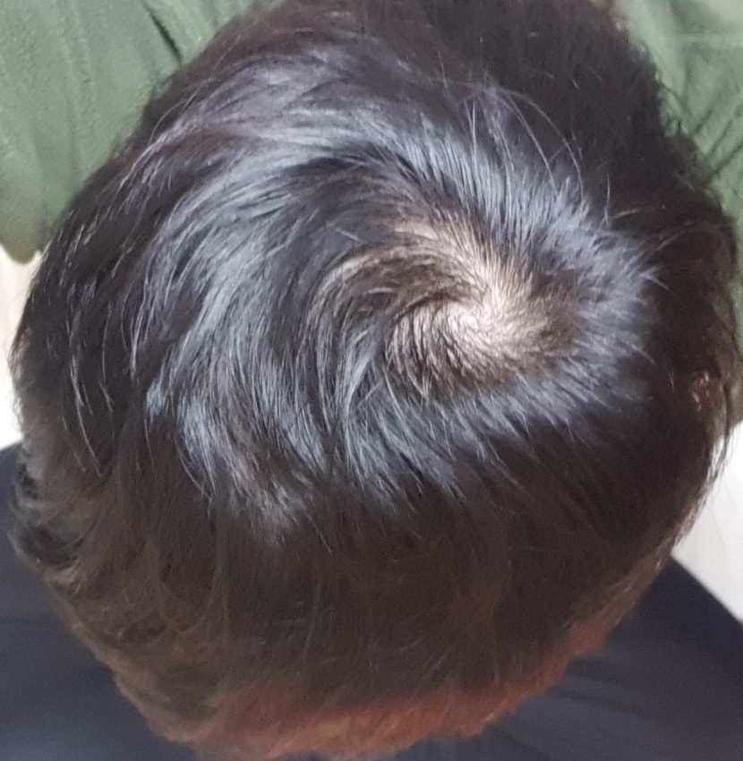 3개월 후 정수리