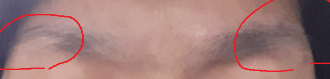 눈썹탈모2.PNG