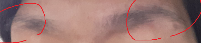 눈썹탈모1.PNG
