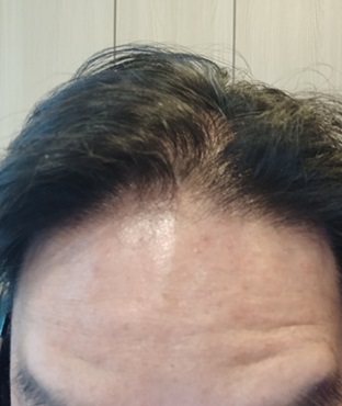 앞머리 탈모 ㅠ.jpg