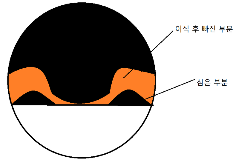 모발이식.png