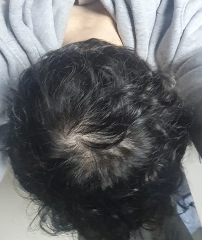 정수리 탈모좀 봐주세요